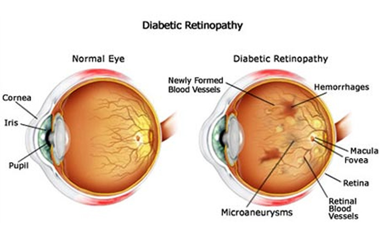 Diabetic Retinopathy (DR)